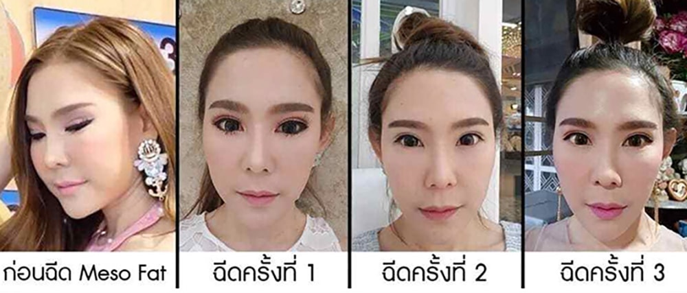 รีวิวฉีดเมโสแฟตหน้า