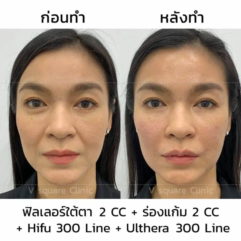 รีวิวฟิลเลอร์ Ulthera Hifu