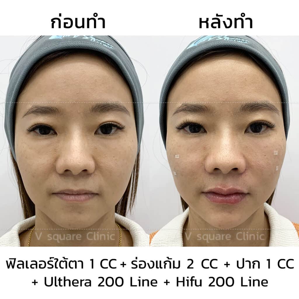 รีวิวฟิลเลอร์ Ulthera Hifu