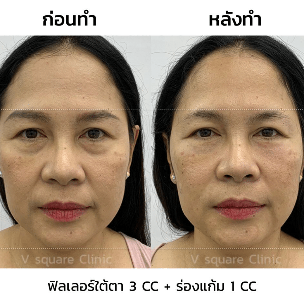 รีวิวฟิลเลอร์ใต้ตา