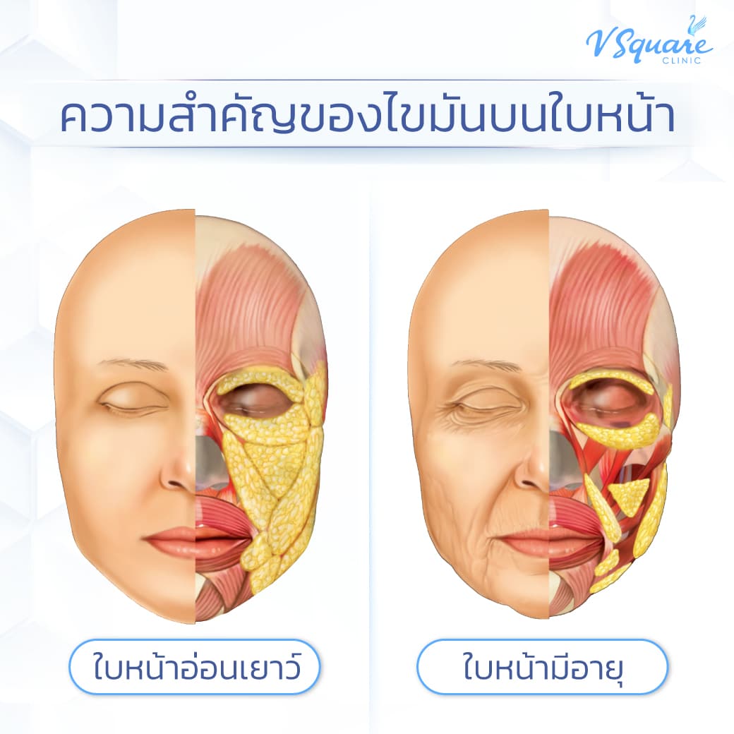 แฟต 1 เข็ม CC มากเกินไป ผลเสีย