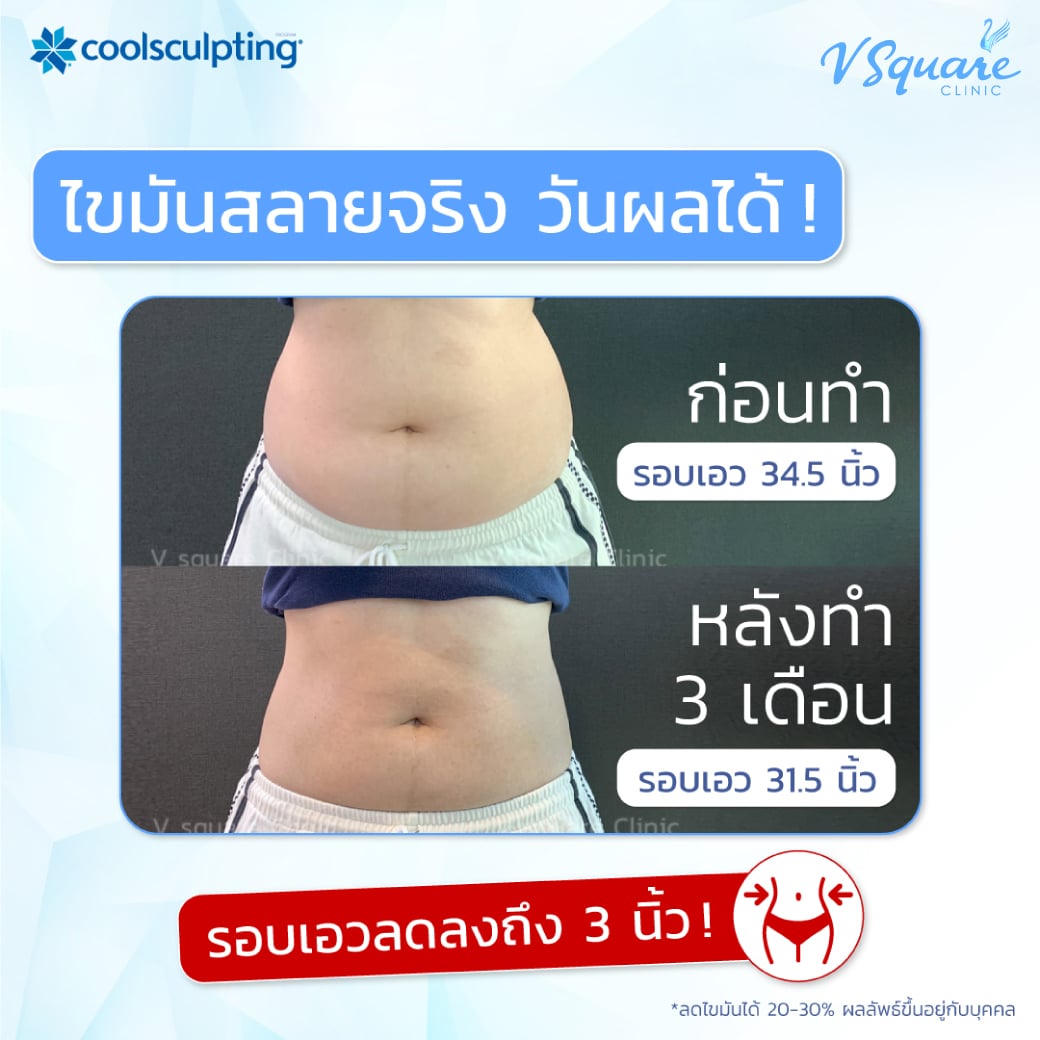 Coolsculpting กี่วันเห็นผล