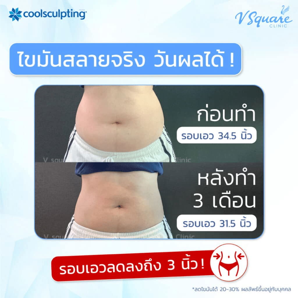 Coolsculpting กี่วันเห็นผล
