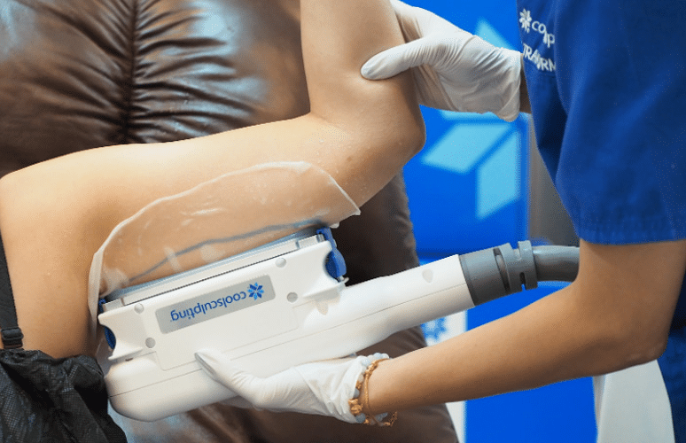 Coolsculpting ต้นแขน