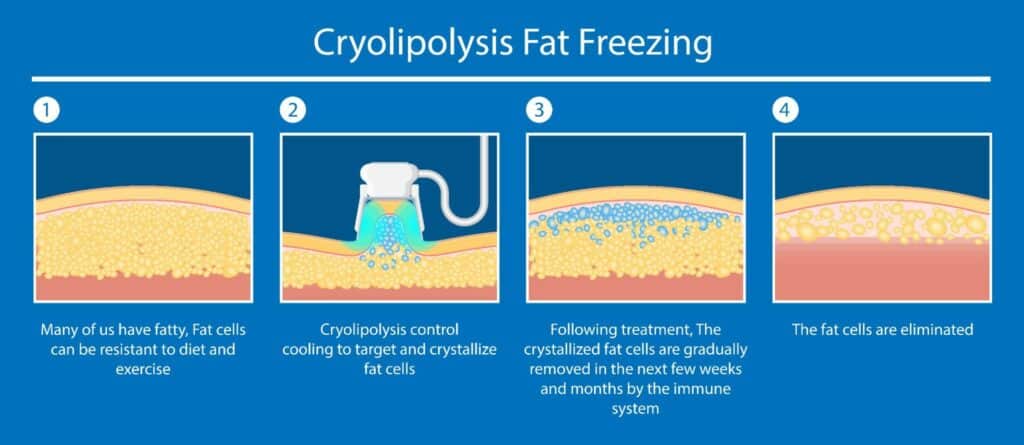 จุดเด่นทำ Coolsculpting สลายไขมัน