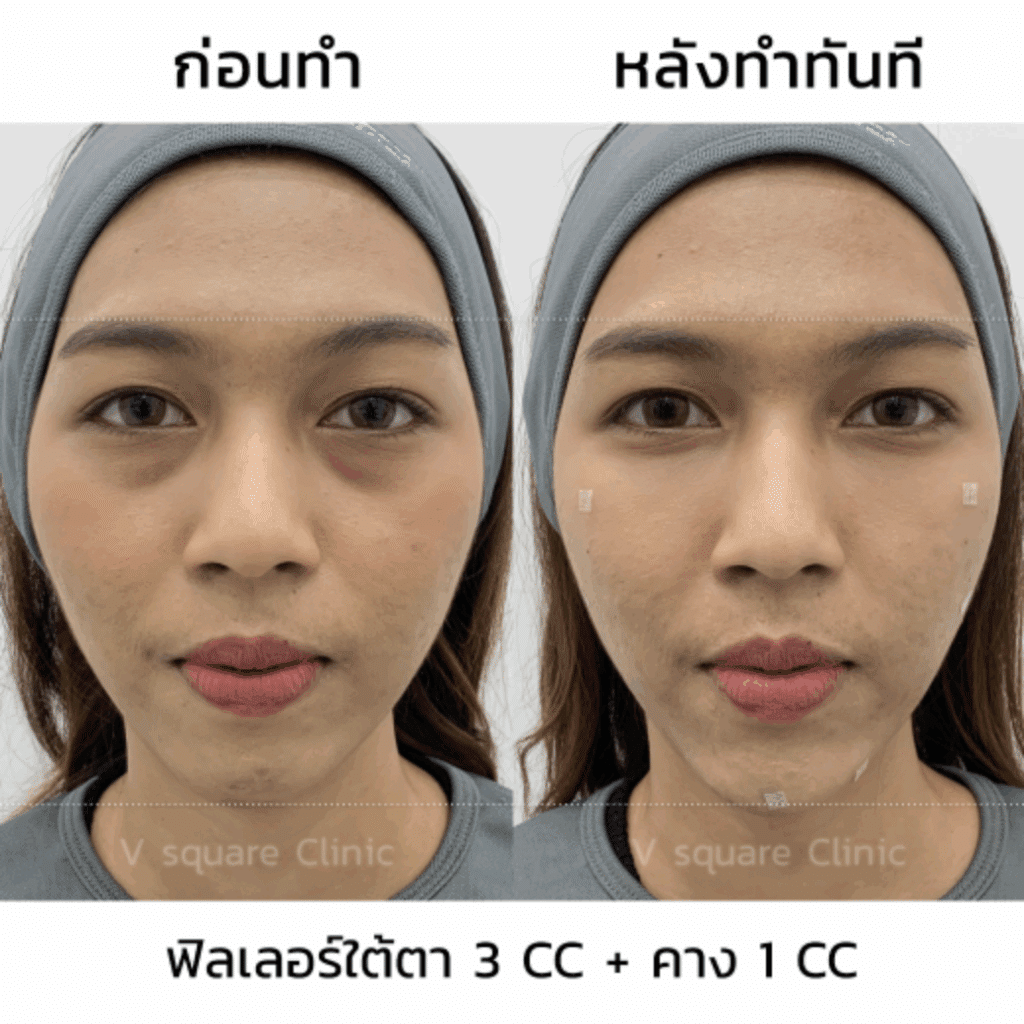 Filler คาง รีวิว เสริมคาง ปรับรูปหน้า_น้องซีน