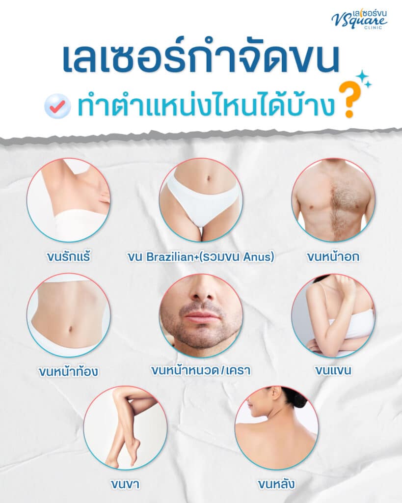 Long Pulse ND Yag Laser กำจัดขน ตำแหน่งไหนได้บ้าง