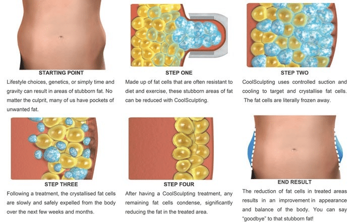 coolsculpting คืออะไร ?