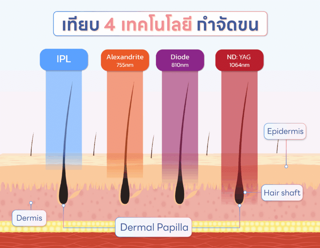 diode laser vs yag