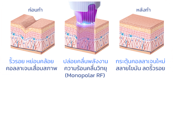 กระบวนการทำงานของ Thermage FLX