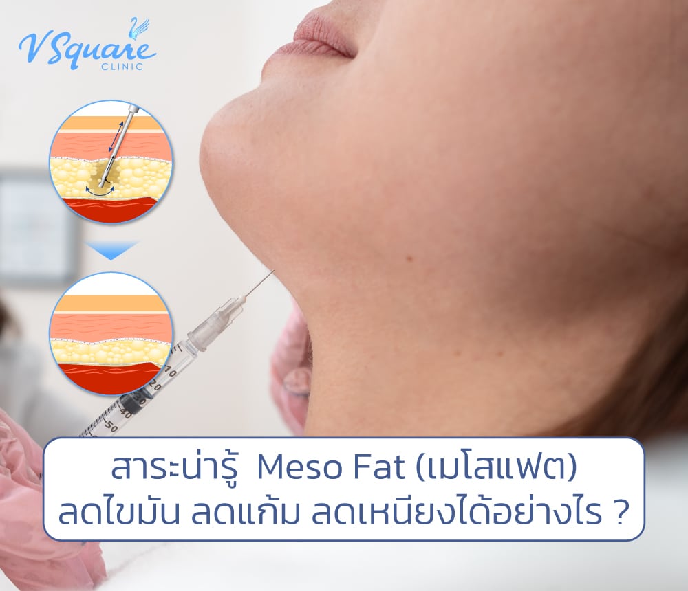 การฉีดเมโสแฟต