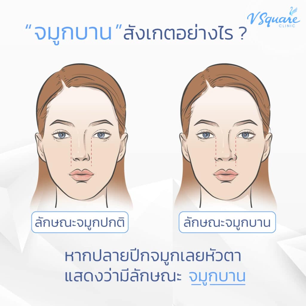 จมูกบาน