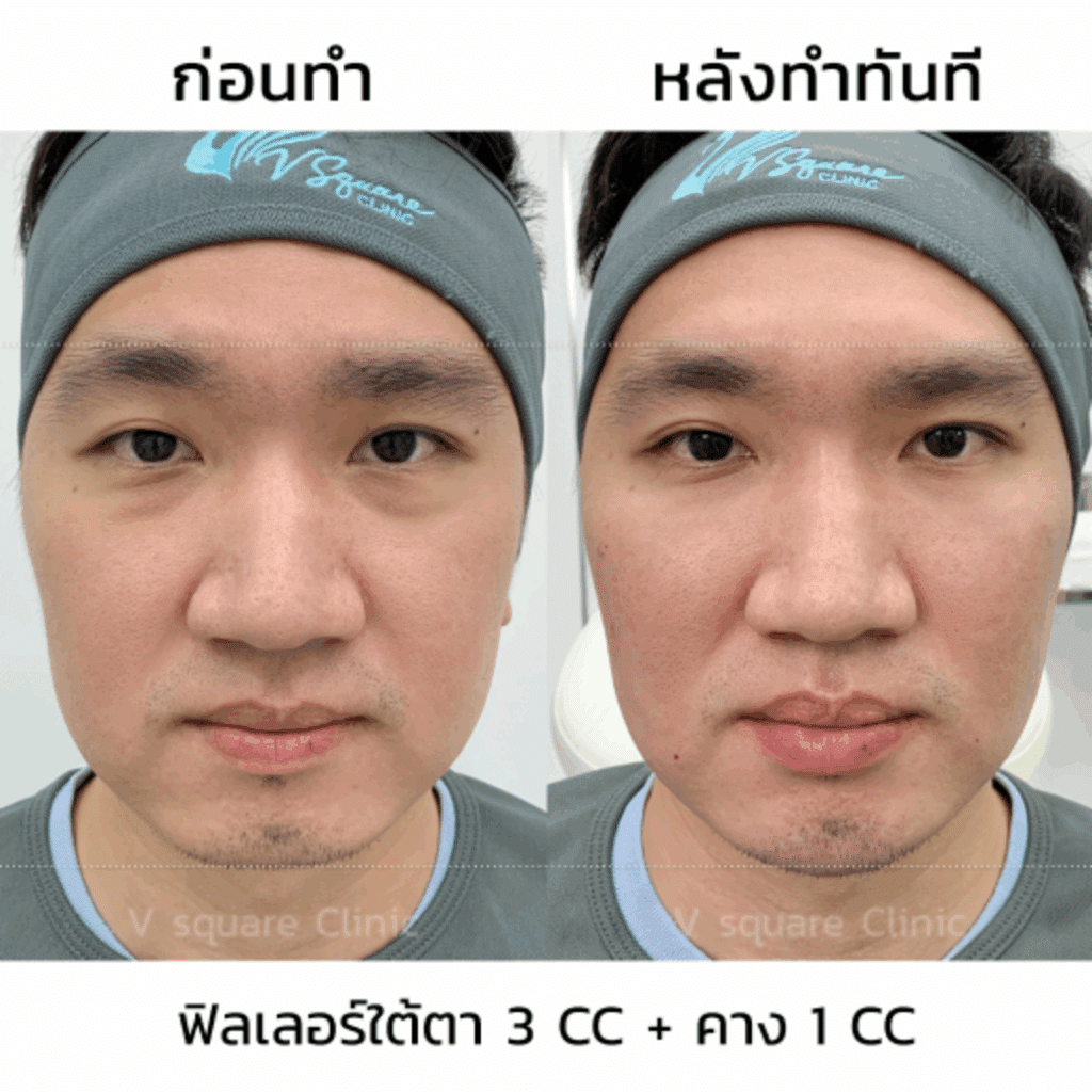 ฉีดคาง รีวิว แก้ปัญหาคางตัด_คุณมิ้นต์