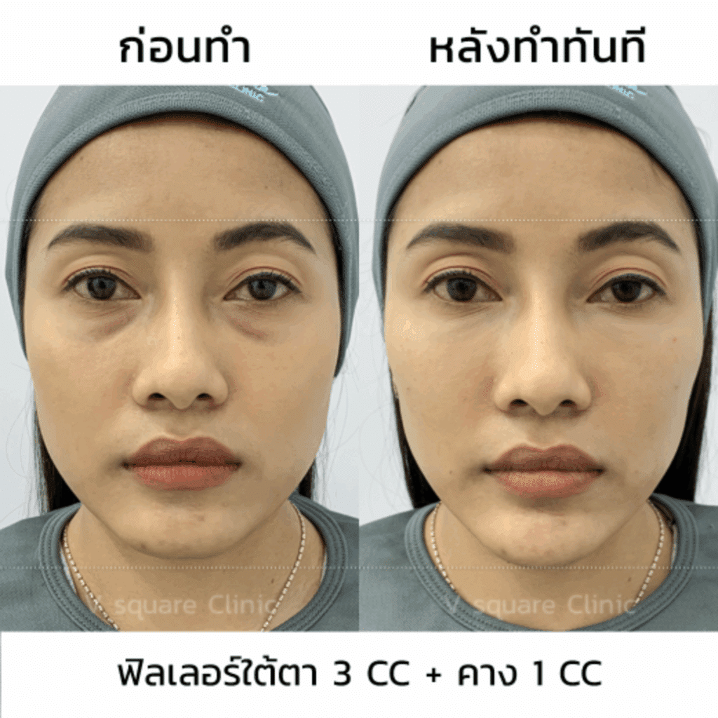 ฉีดคาง รีวิว แก้ปัญหาคางตัด_พี่วา