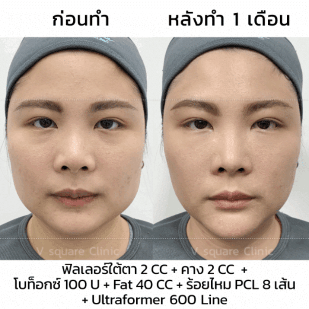 ฉีดฟิลเลอร์คาง รีวิว แก้ปัญหาหน้ากลม_พี่จีน