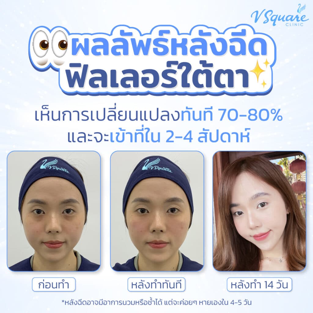 ฉีดฟิลเลอร์ใต้ตา กี่วันเห็นผล