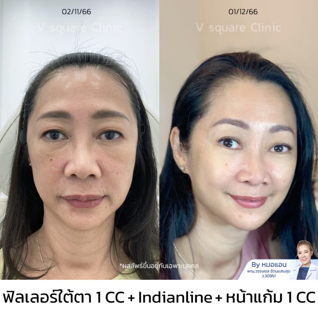 ฉีดฟิลเลอร์ใต้ตา รีวิว_คุณกฤติกา