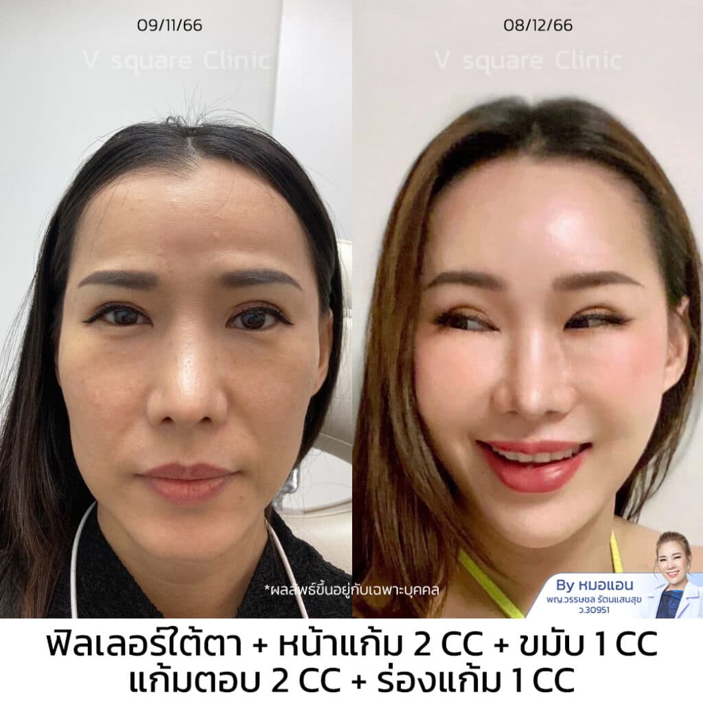 ฉีดฟิลเลอร์ใต้ตา รีวิว_คุณพิมพ์นิภา