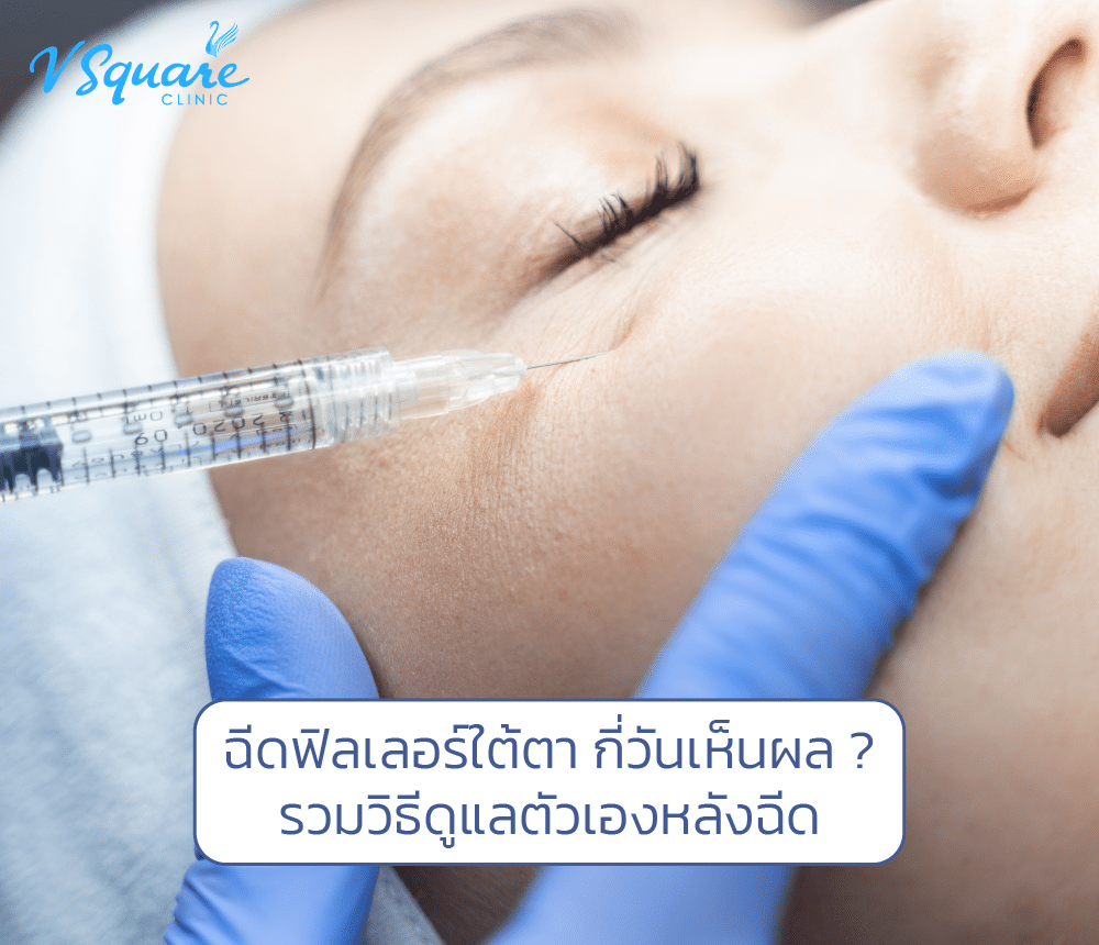 ฉีดฟิลเลอร์ใต้ตากี่วันเห็นผล
