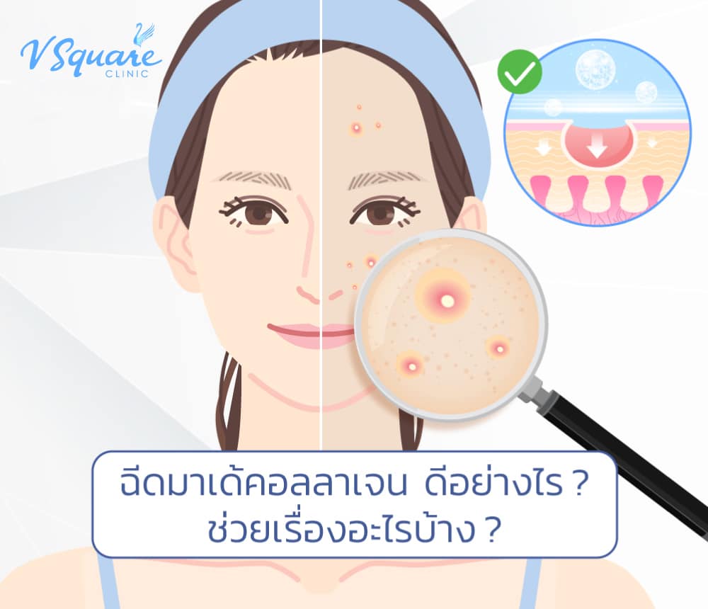 ฉีดมาเด้