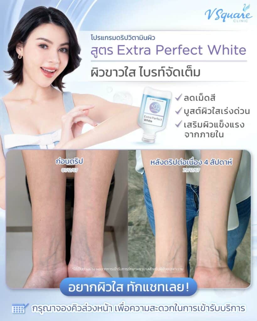 ฉีดวิตามินผิวขาวจริงไหม รีวิว
