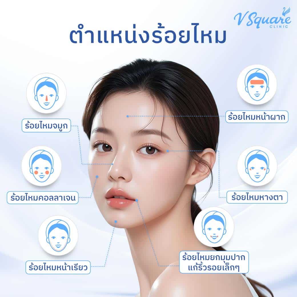 ตำแหน่งร้อยไหม