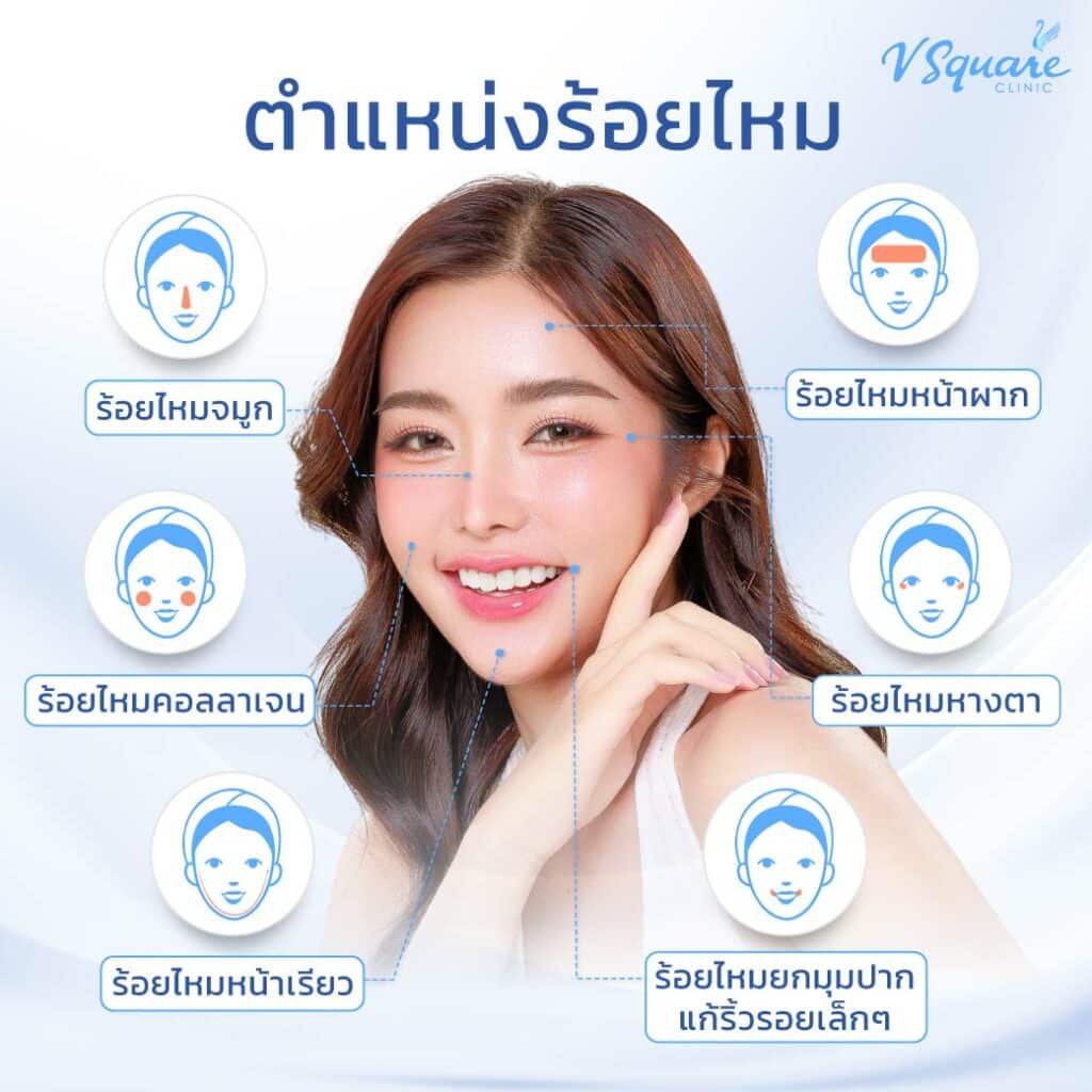 ตำแหน่งร้อยไหม