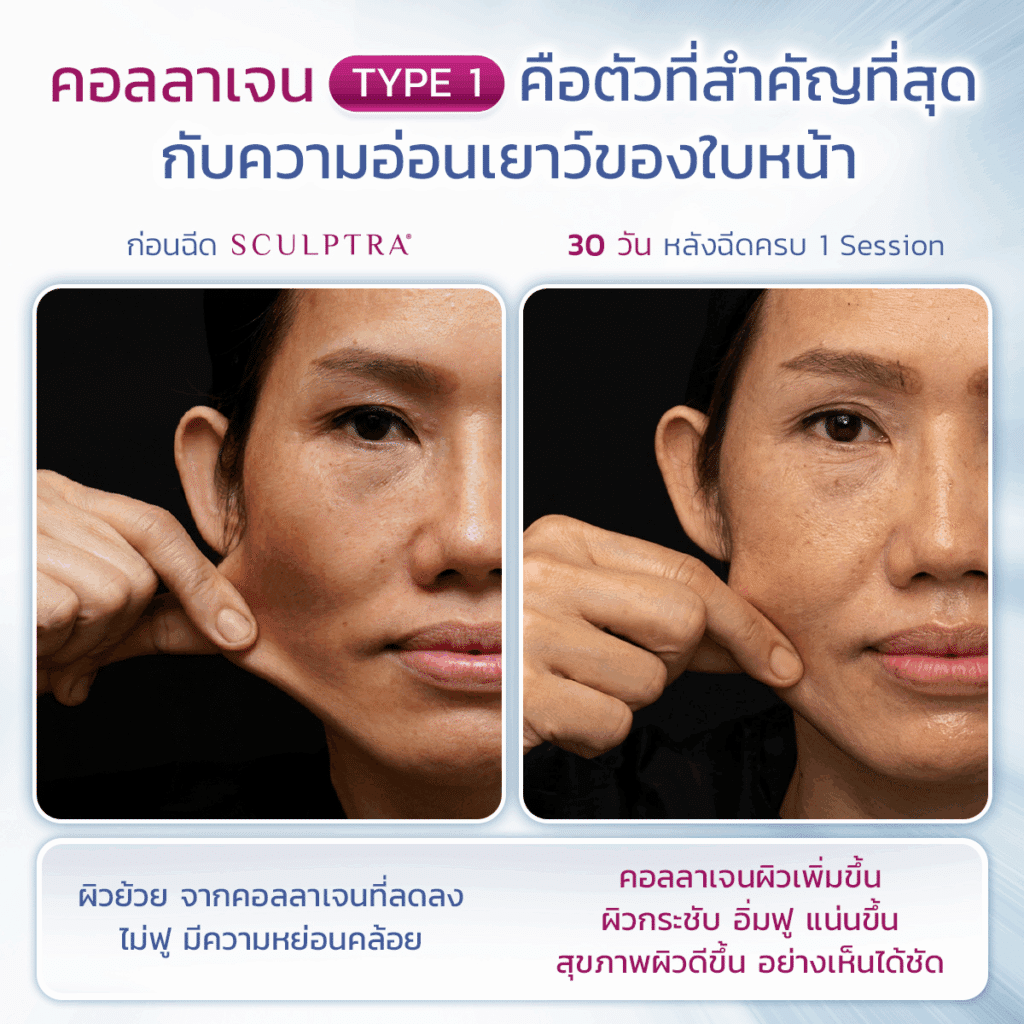 ทำ Sculptra ราคาคุ้ม