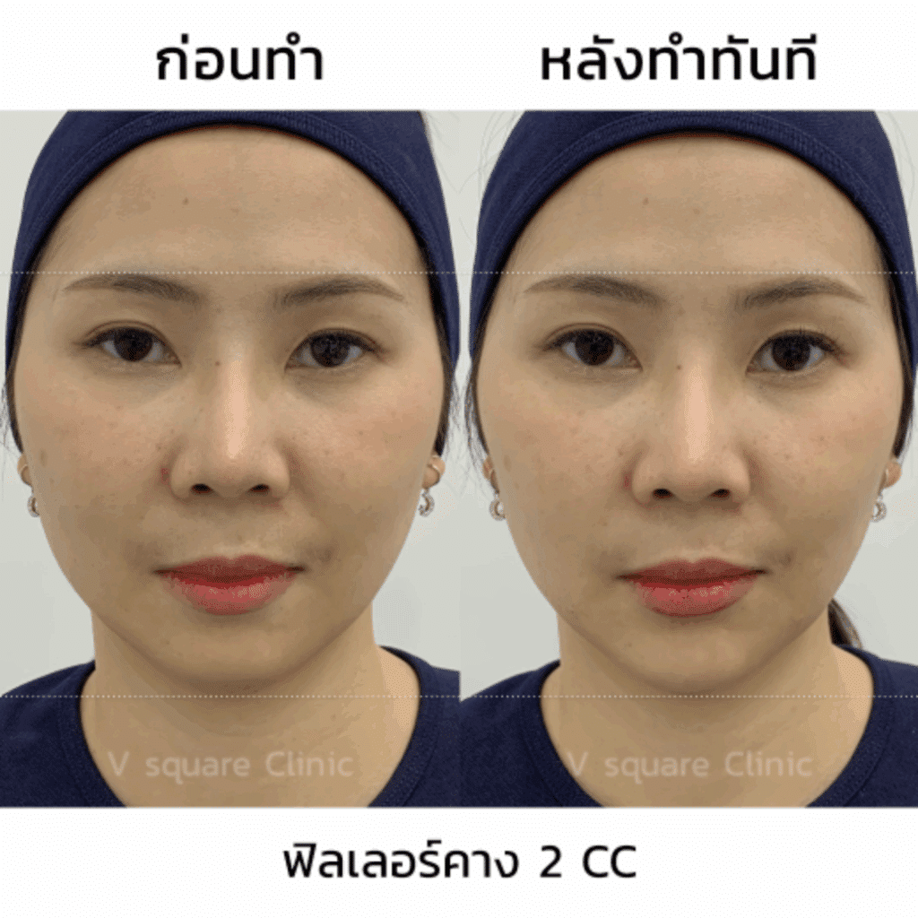 ฟิลเลอร์คาง รีวิว แก้ปัญหาคางสั้น_คุณกิ๊ก Influencer
