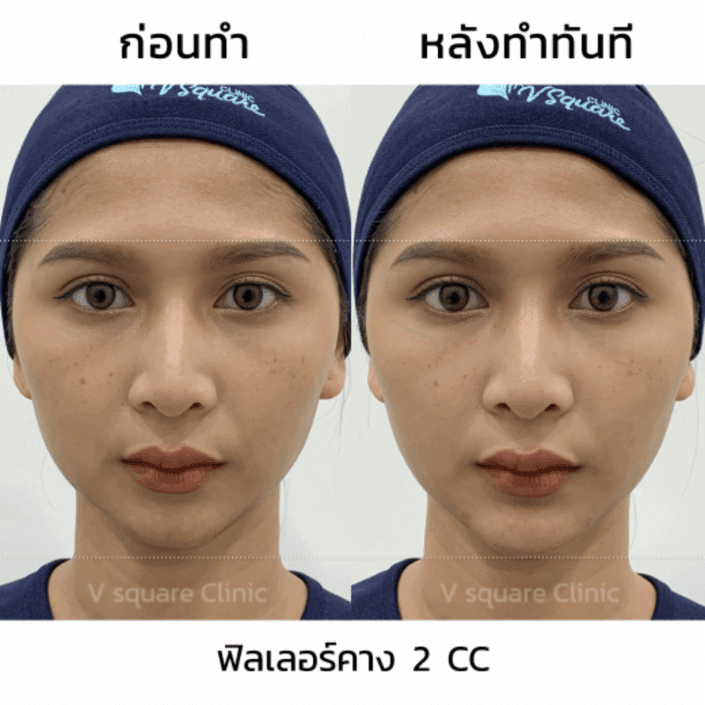 ฟิลเลอร์คาง รีวิว แก้ปัญหาคางสั้น_พี่ครีมInfluencer