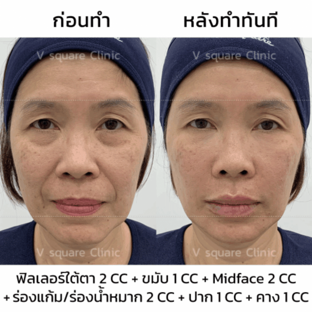 ฟิลเลอร์คาง รีวิว แก้ปัญหาคางสั้น_พี่อ้อย