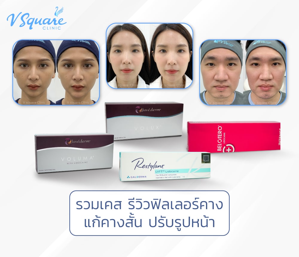 ฟิลเลอร์คาง รีวิว