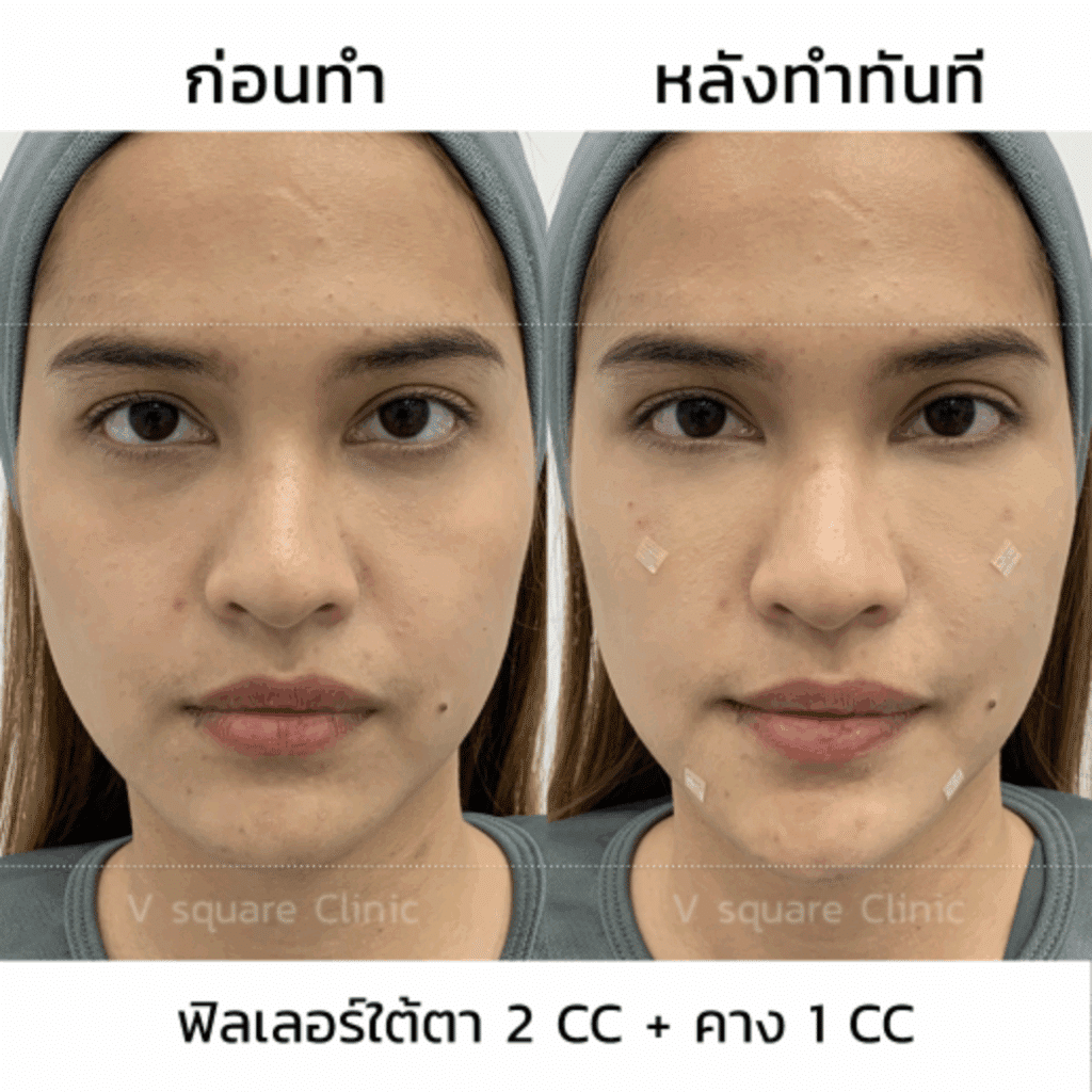 ฟิลเลอร์คางรีวิว แก้ปัญหาคางสั้น_พี่ทราย