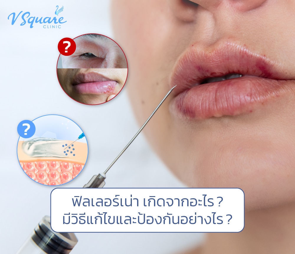 ฟิลเลอร์เน่า