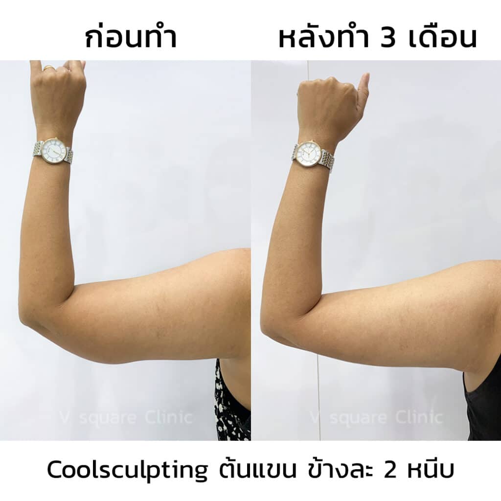 รีวิว Coolsculpting ต้นแขน
