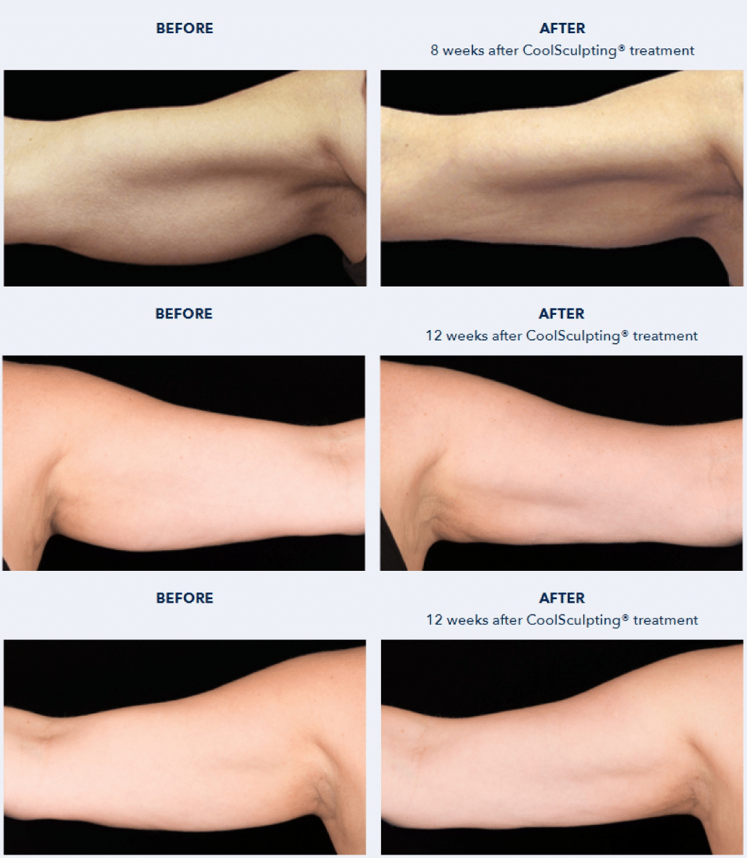 รีวิว Coolsculpting ต้นแขน