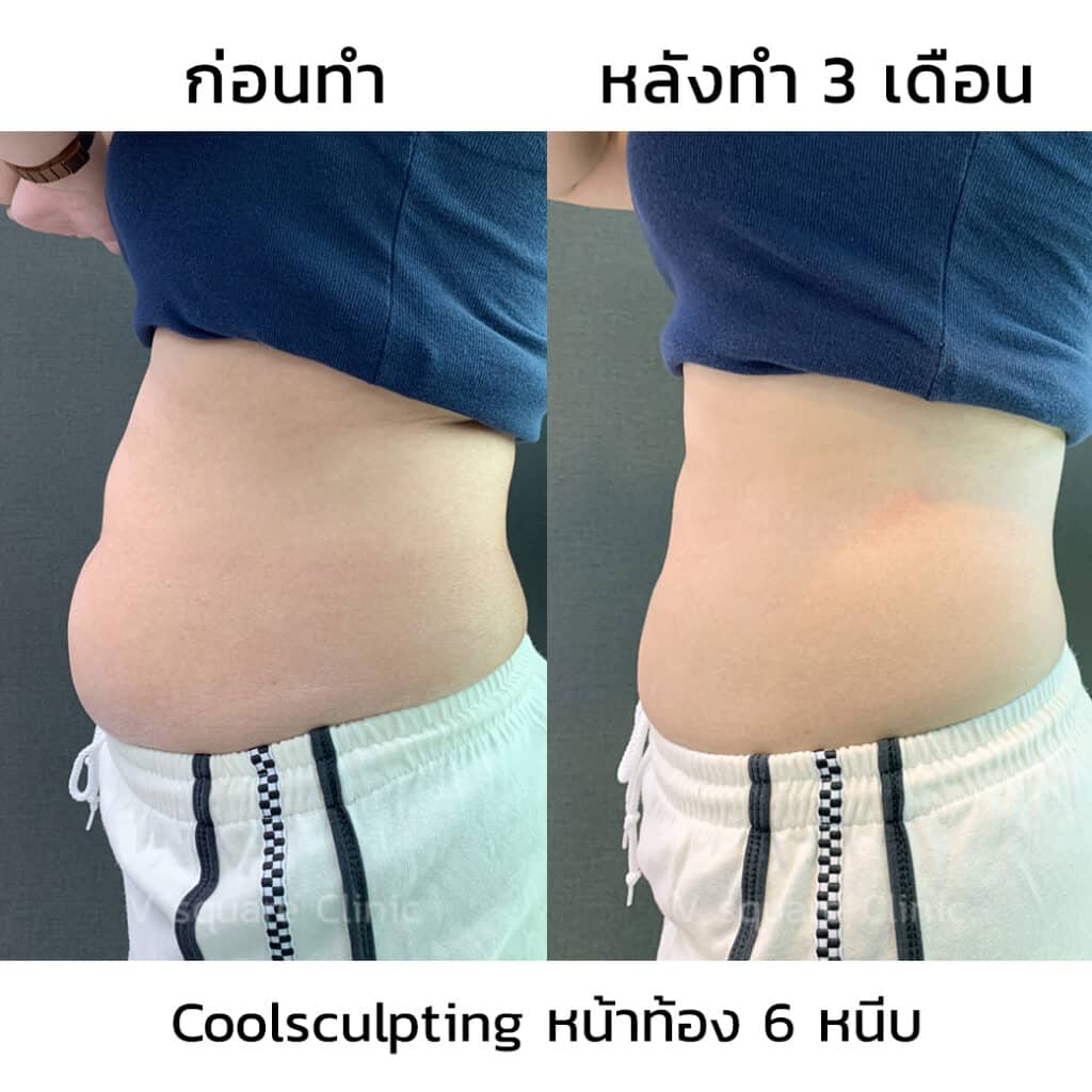 รีวิว Coolsculpting หน้าท้อง