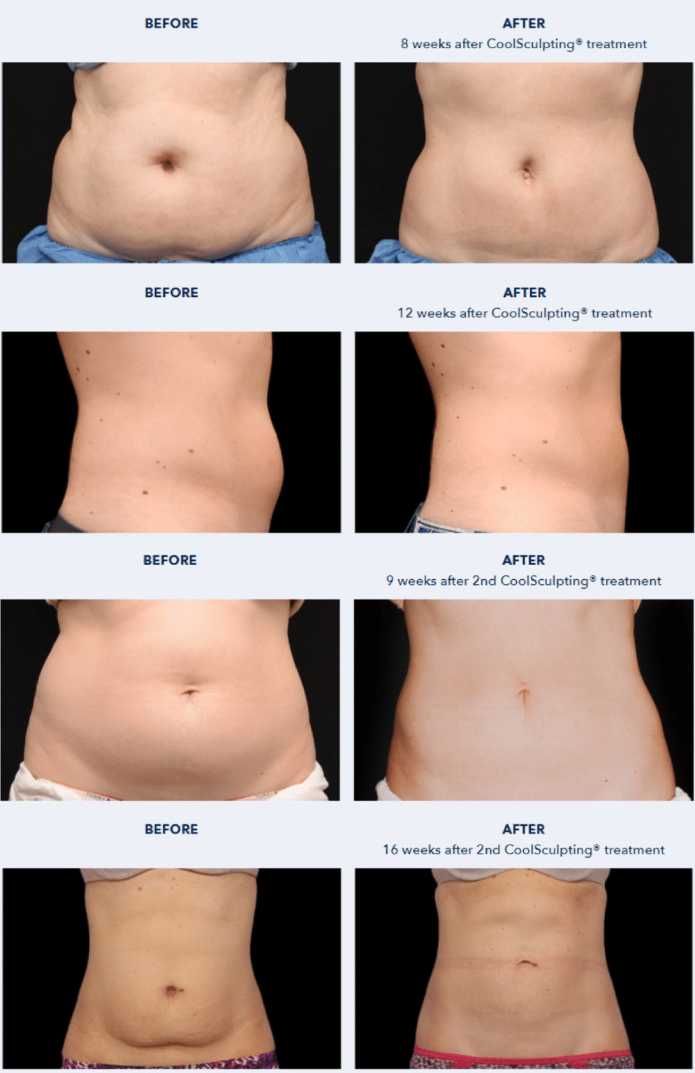 รีวิว Coolsculpting หน้าท้อง ห่วงยาง