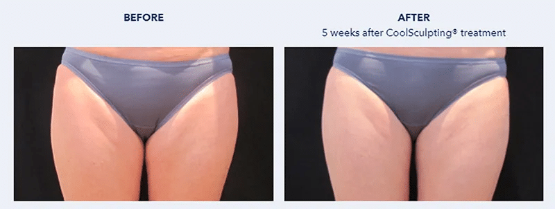 รีวิว Coolsculptingต้นขา