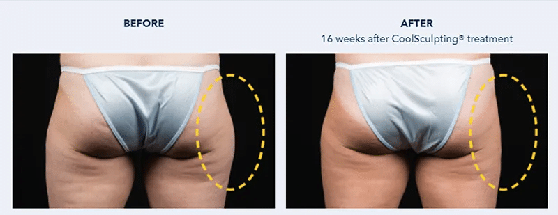 รีวิว Coolsculptingสะโพก