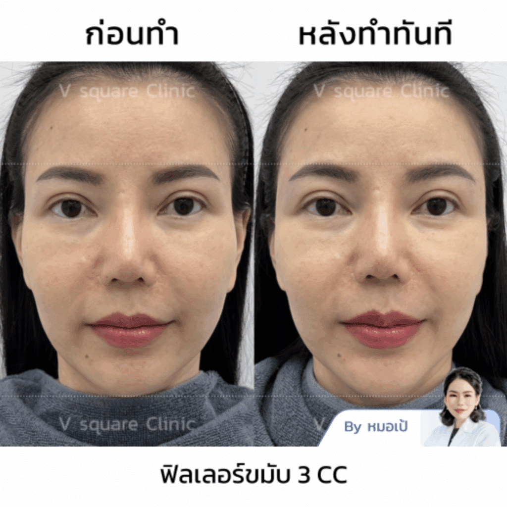 รีวิว Filler คาง ยี่ห้อผ่าน อย