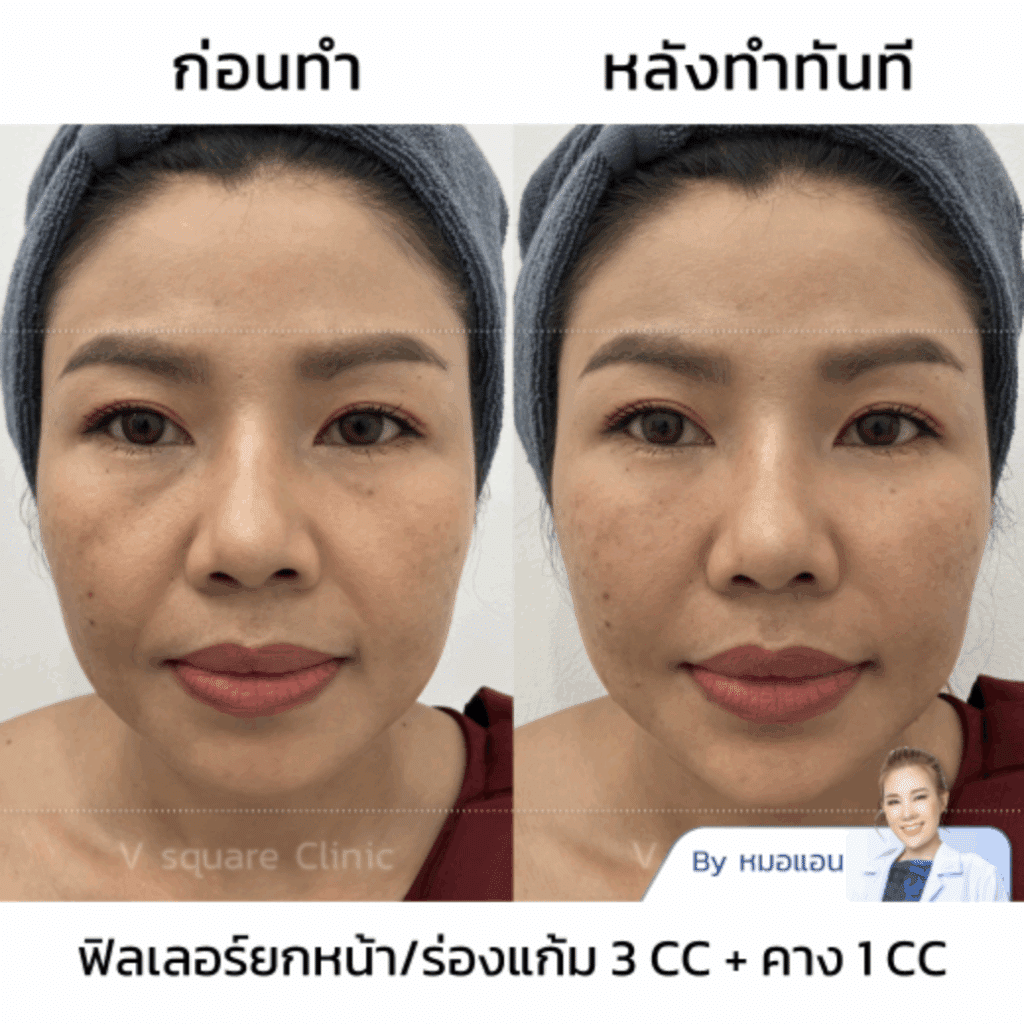 รีวิว Filler คางฉีดยี่ห้อปลอดภัย