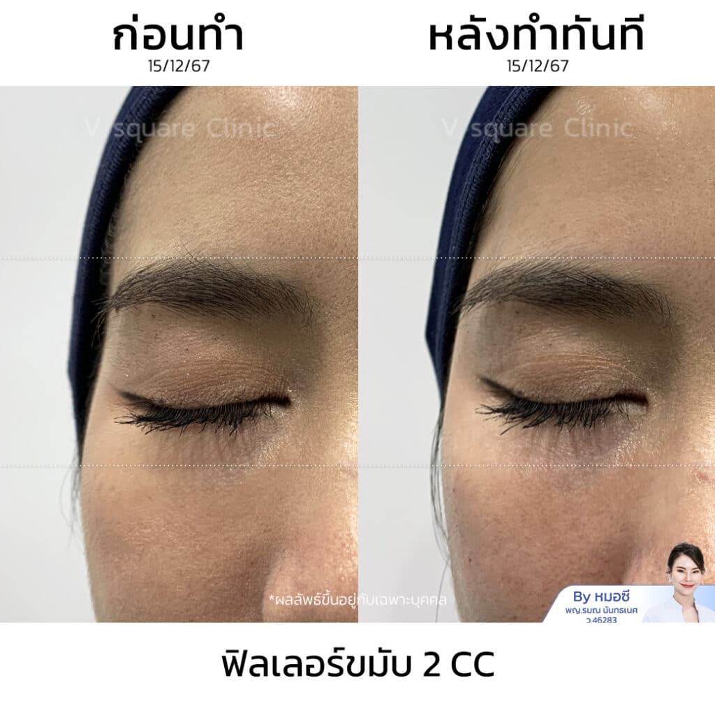 รีวิว Filler ราคามาตรฐาน