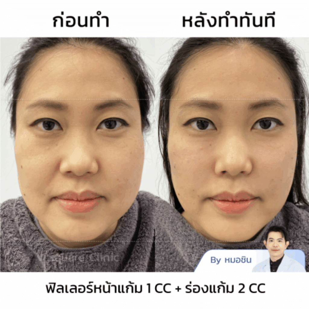 รีวิว Filler ร่องแก้ม
