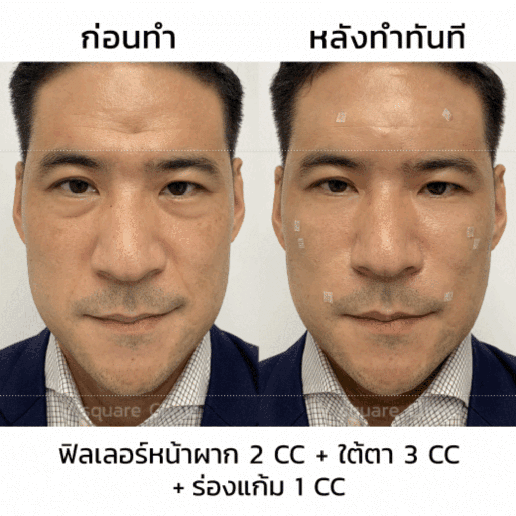 รีวิว Filler หน้าผาก