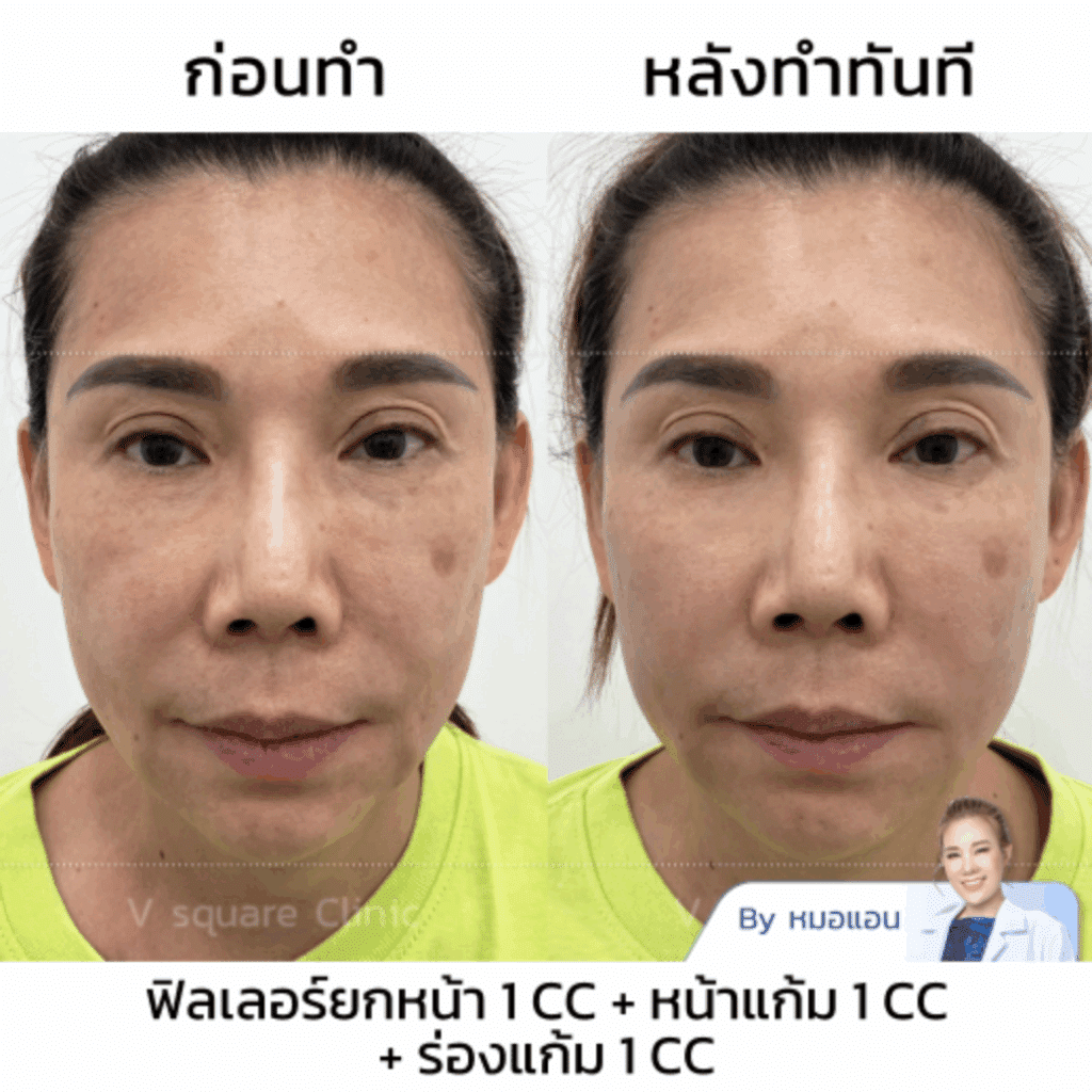 รีวิว Filler แก้มส้ม