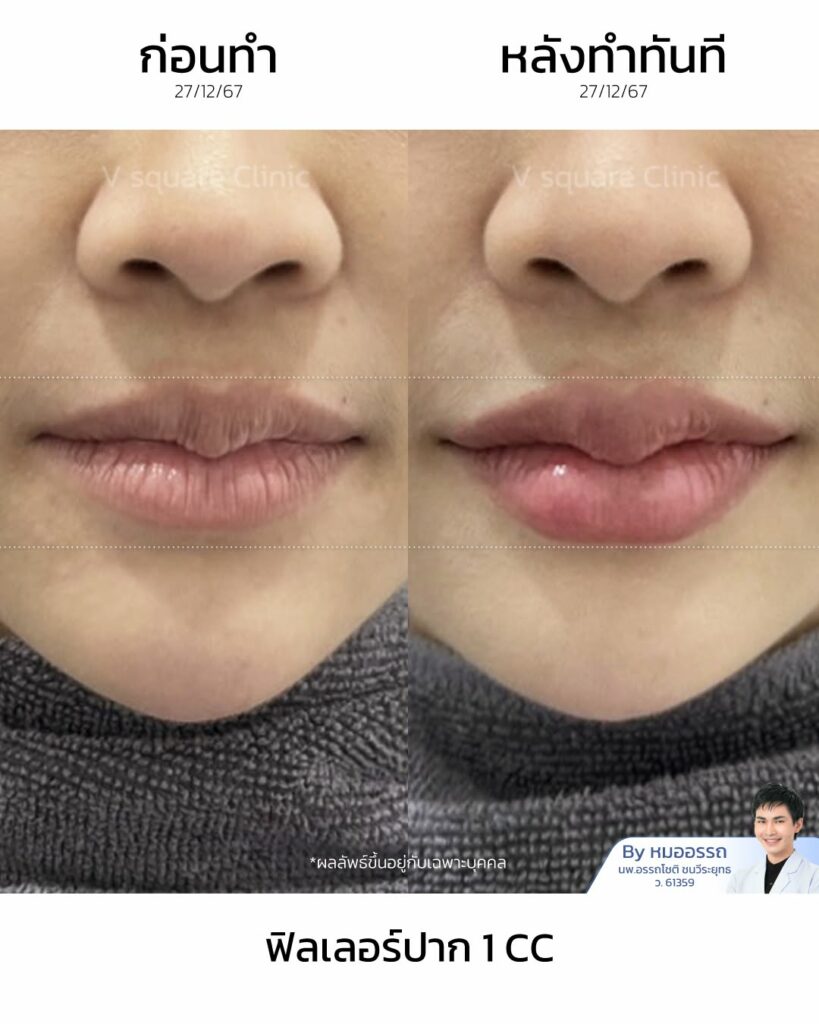 รีวิว Filler แก้มส้มยี่ห้อที่ปลอดภัย