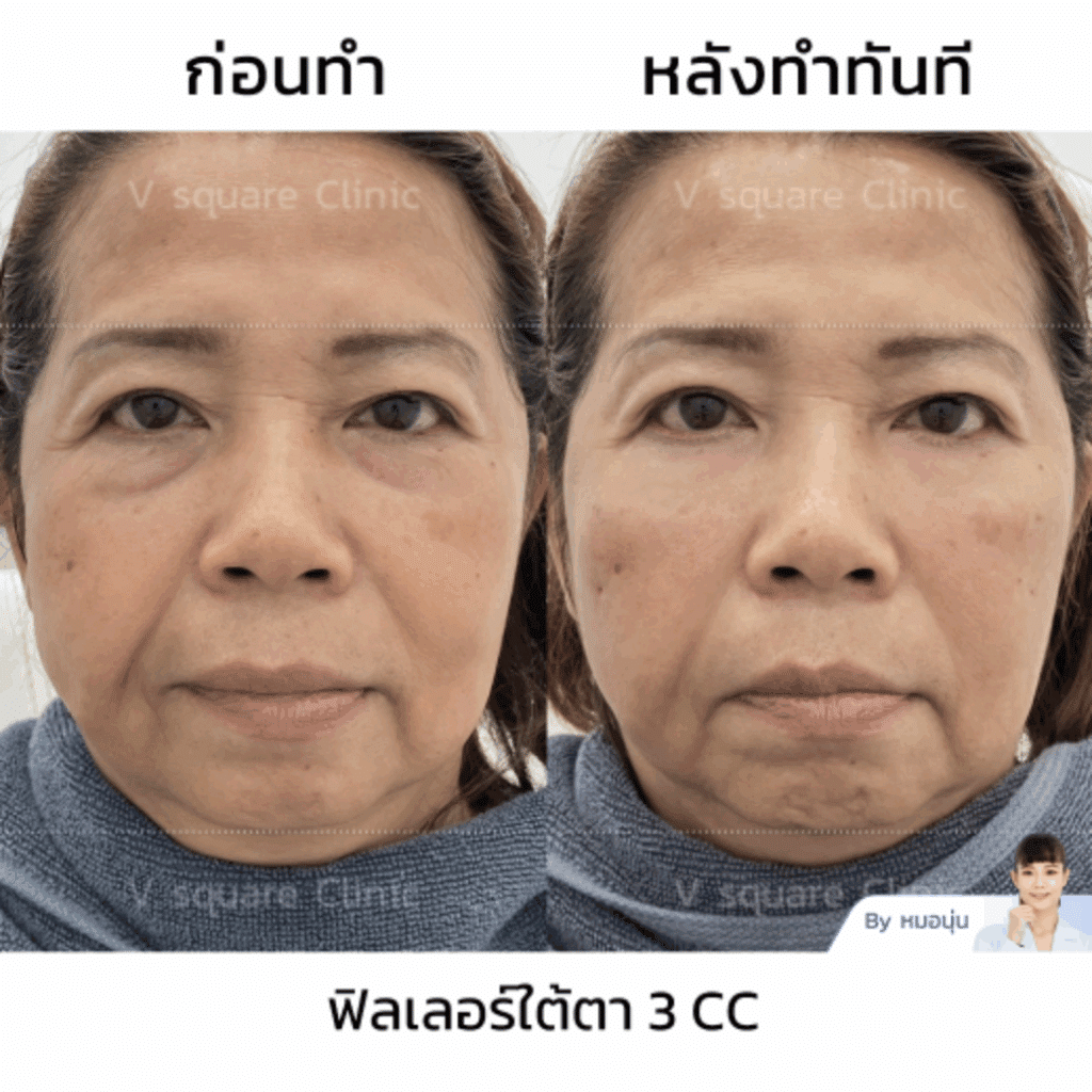 รีวิว Filler ใต้ตายี่ห้อปลอดภัย