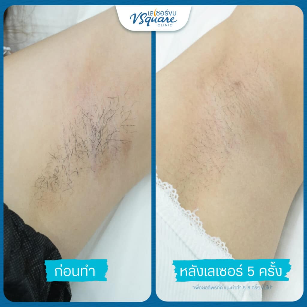 เลเซอร์ขนรักแร้ รีวิว