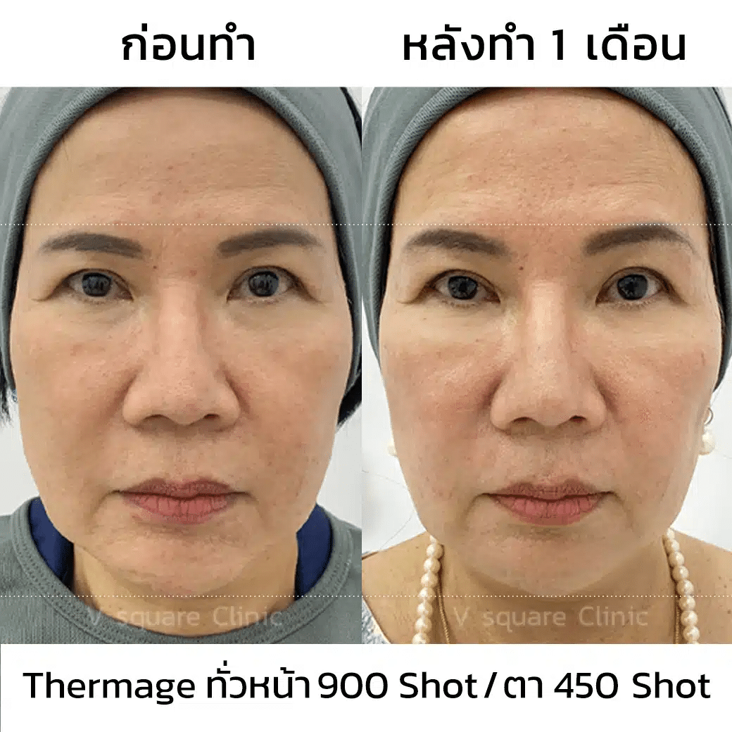 รีวิว Thermage ทั่วหน้า 900 Shot